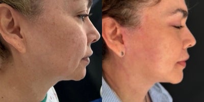 Neck Lift before and after photo