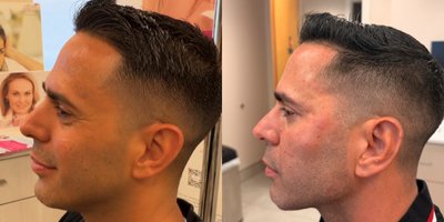 Restylane before and after photo