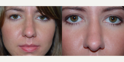 Rhinoplasty before and after photo