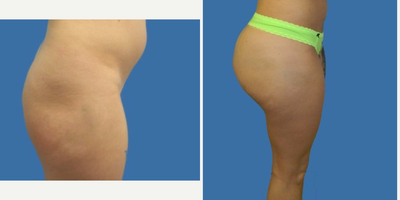 Brazilian Butt Lift before and after photo