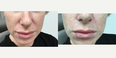 Dermal Fillers before and after photo