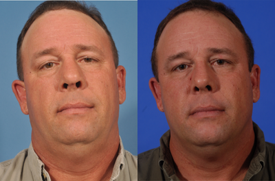 Rhinoplasty before and after photo