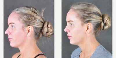 Rhinoplasty before and after photo