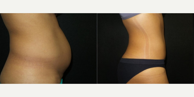 Tummy Tuck before and after photo