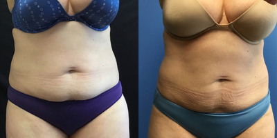 CoolSculpting before and after photo