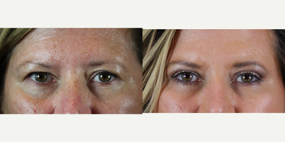 Eyelid Surgery before and after photo
