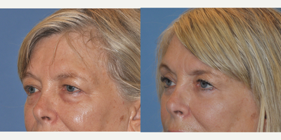 Fraxel Repair before and after photo