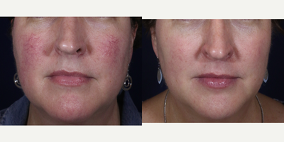 Vbeam before and after photo