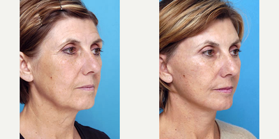 Brow Lift before and after photo
