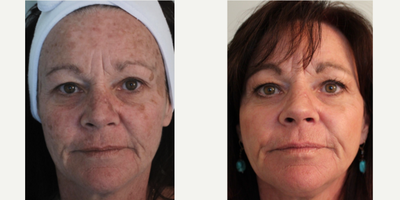 CO2 Laser before and after photo