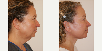 Facelift before and after photo