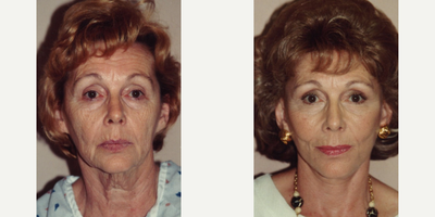 Facelift before and after photo