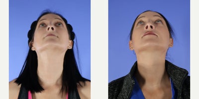 Rhinoplasty before and after photo