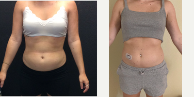 SculpSure before and after photo