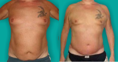 Tummy Tuck before and after photo