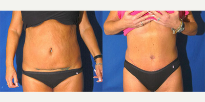 Tummy Tuck before and after photo
