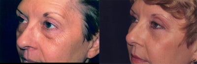 ActiveFX before and after photo