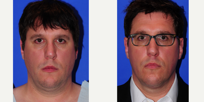 Facelift before and after photo