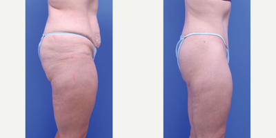 Butt Lift before and after photo