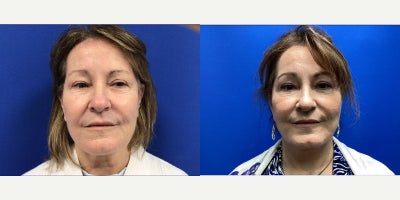 Facelift before and after photo