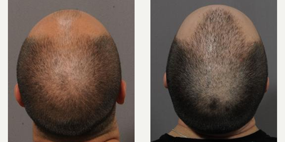 FUE Hair Transplant before and after photo