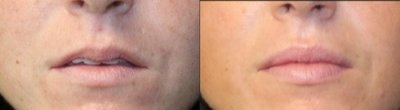 Lip Fillers before and after photo