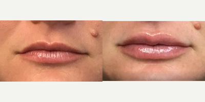 Juvederm before and after photo