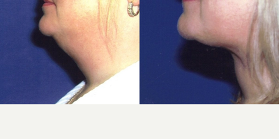 Liposuction before and after photo