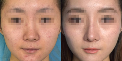 Asian Rhinoplasty before and after photo