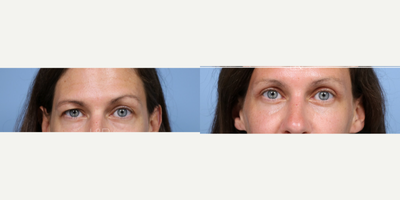 Brow Lift before and after photo