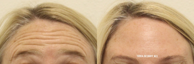 Dysport before and after photo