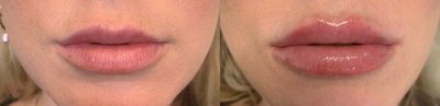 Lip Fillers before and after photo