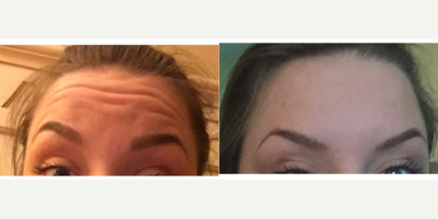 Botox before and after photo