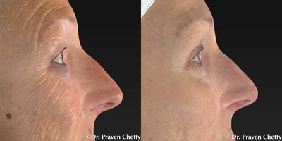 Microneedling before and after photo