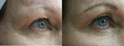 Skin Tightening before and after photo