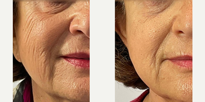 Thread Lift before and after photo