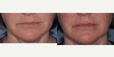 Belotero before and after photo
