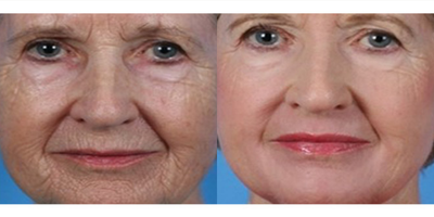 eMatrix before and after photo