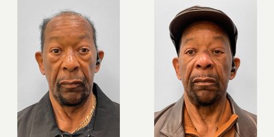Eyelid Surgery before and after photo