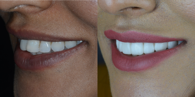 Porcelain Veneers before and after photo