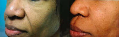 Radiesse before and after photo