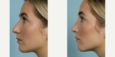 Rhinoplasty before and after photo