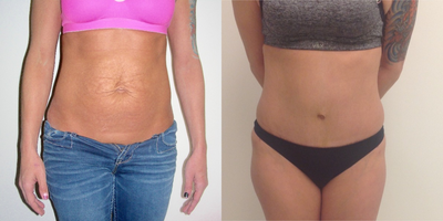Tummy Tuck before and after photo