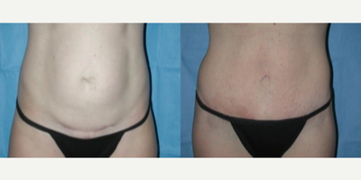 Tummy Tuck before and after photo