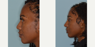 African American Rhinoplasty before and after photo