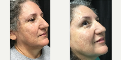 Dysport before and after photo