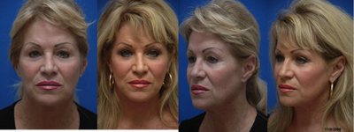 Facelift before and after photo