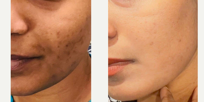 Skin Lightening before and after photo