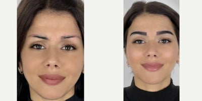 Eyebrow Transplant before and after photo