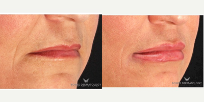 Lip Fillers before and after photo